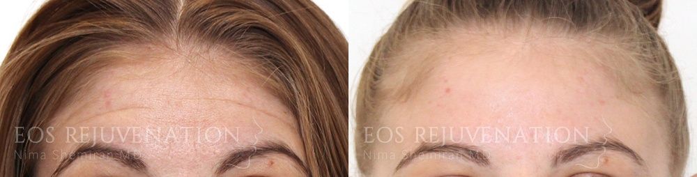 Botox Dysport Before & After