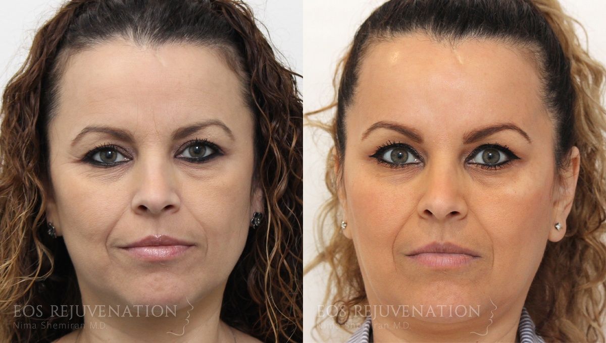 Botox Dysport Before & After