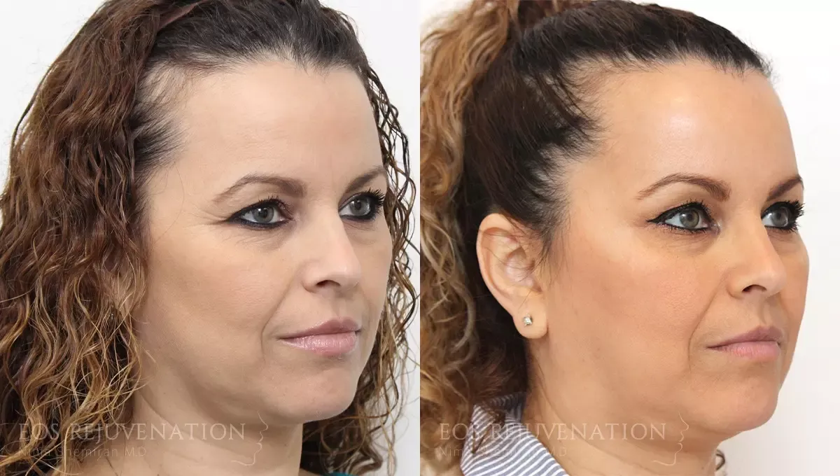 Botox Dysport Before & After