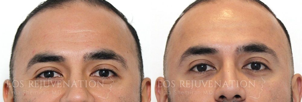 Botox Dysport Before & After