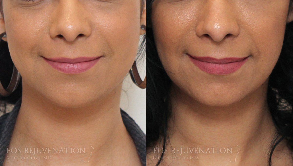 Botox Dysport Before & After