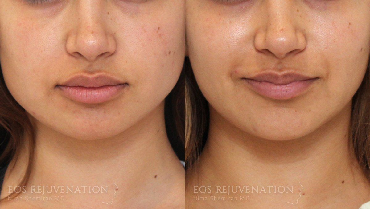 Botox Dysport Before & After