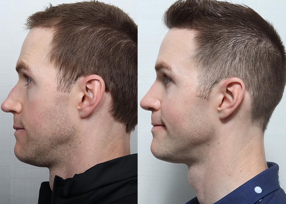 Male Rhinoplasty Before & After