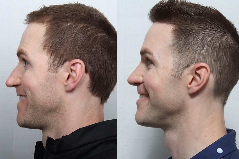 Male Rhinoplasty Before & After