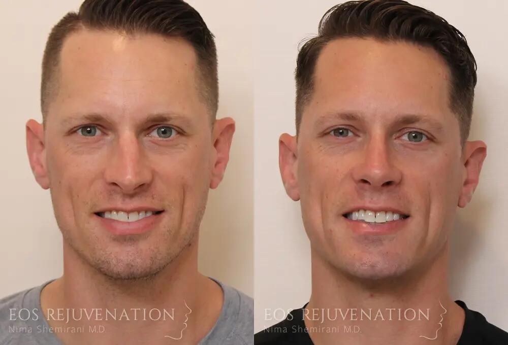 Male Rhinoplasty Before & After