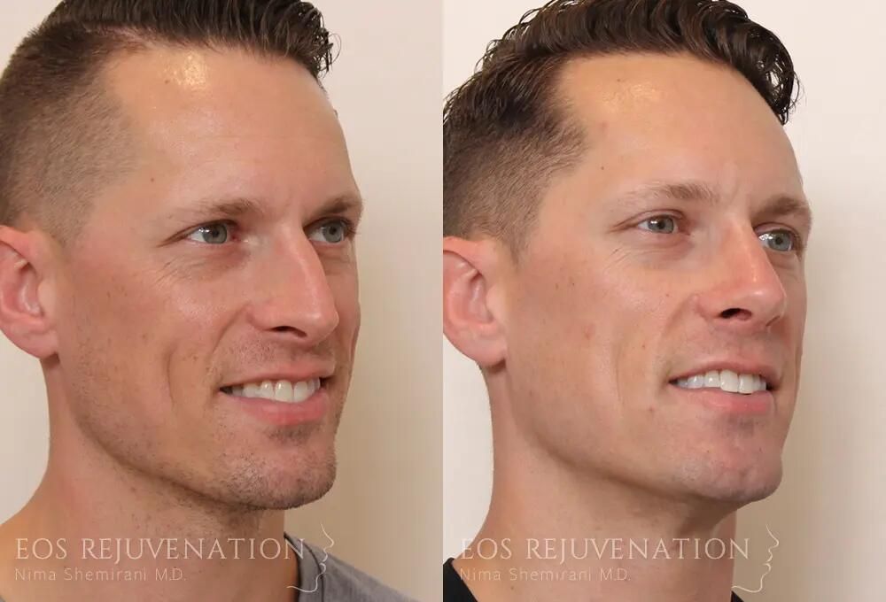 Male Rhinoplasty Before & After
