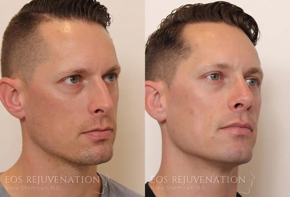 Male Rhinoplasty Before & After