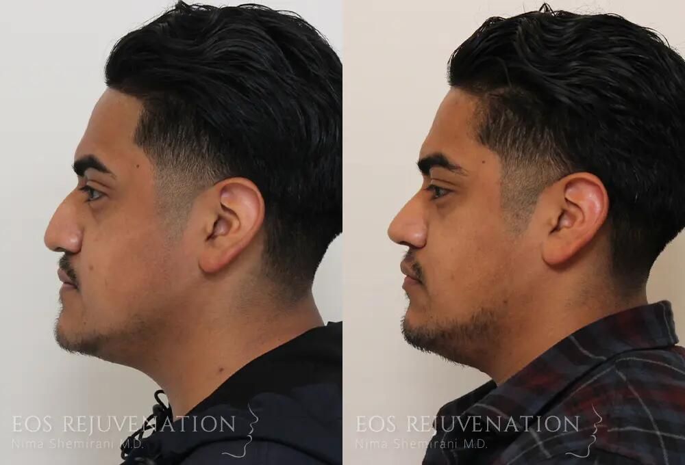 Male Rhinoplasty Before & After