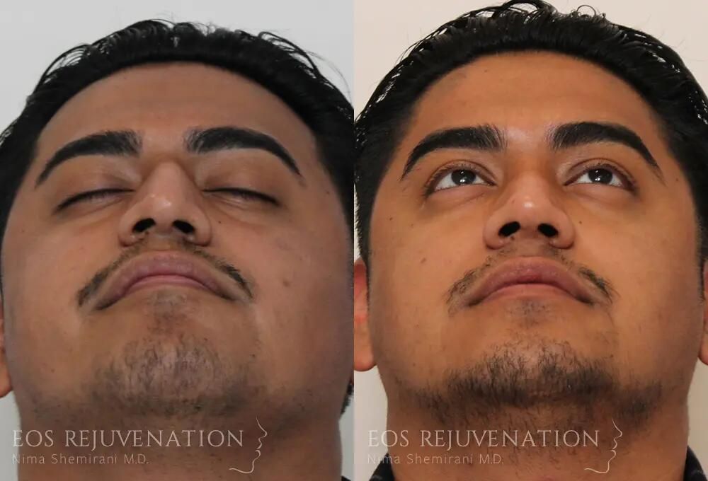 Male Rhinoplasty Before & After