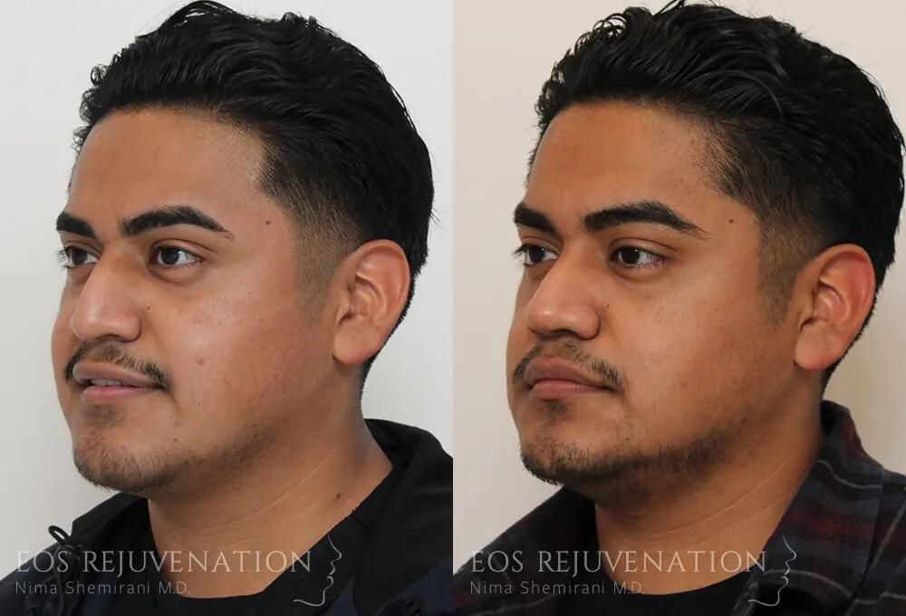 Male Rhinoplasty Before & After