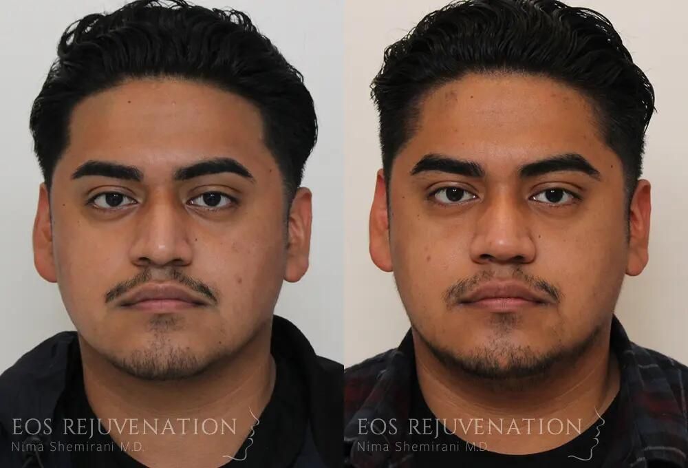 Male Rhinoplasty Before & After