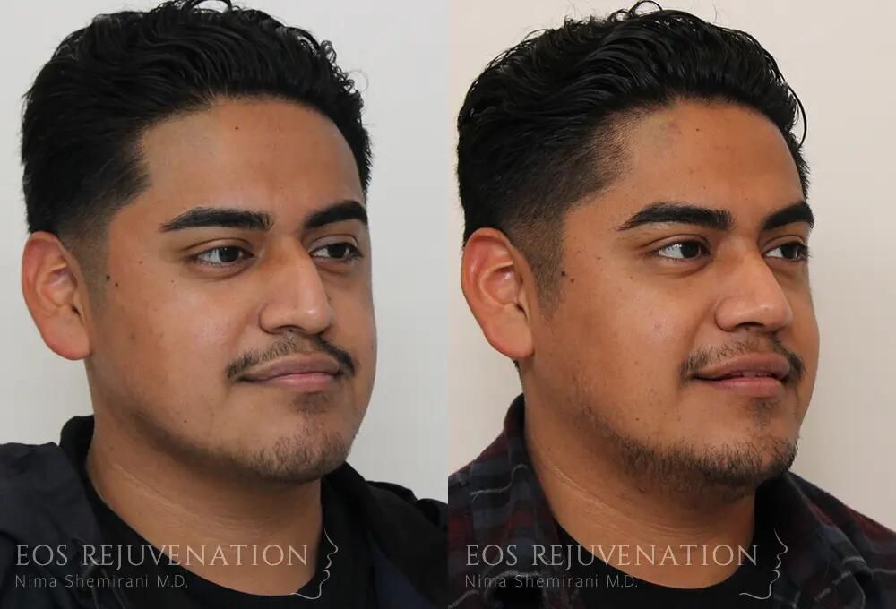Male Rhinoplasty Before & After