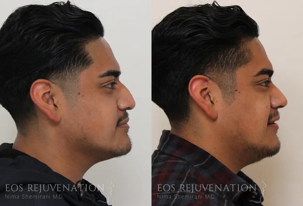 Male Rhinoplasty Before & After