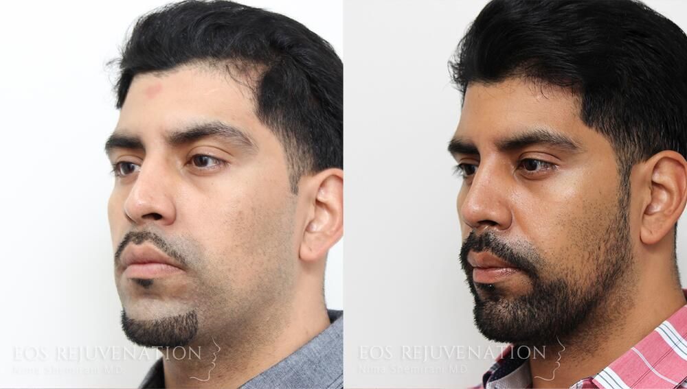 Male Rhinoplasty Before & After