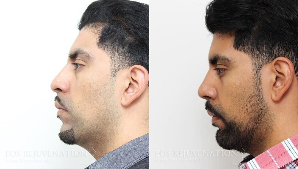 Male Rhinoplasty Before & After