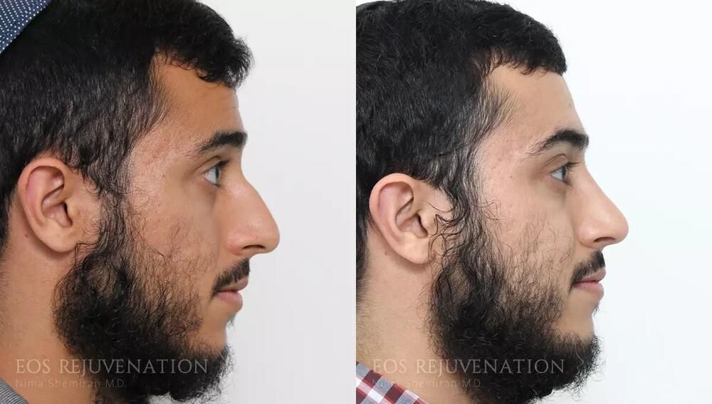 Male Rhinoplasty Before & After