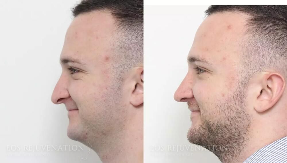 Male Rhinoplasty Before & After