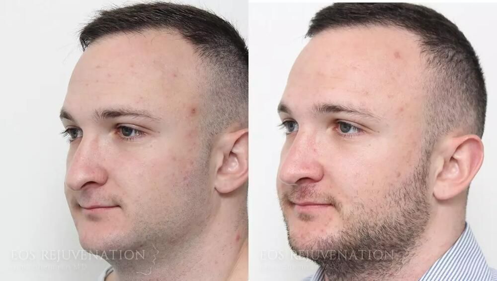 Male Rhinoplasty Before & After