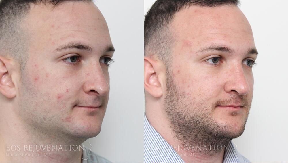 Male Rhinoplasty Before & After