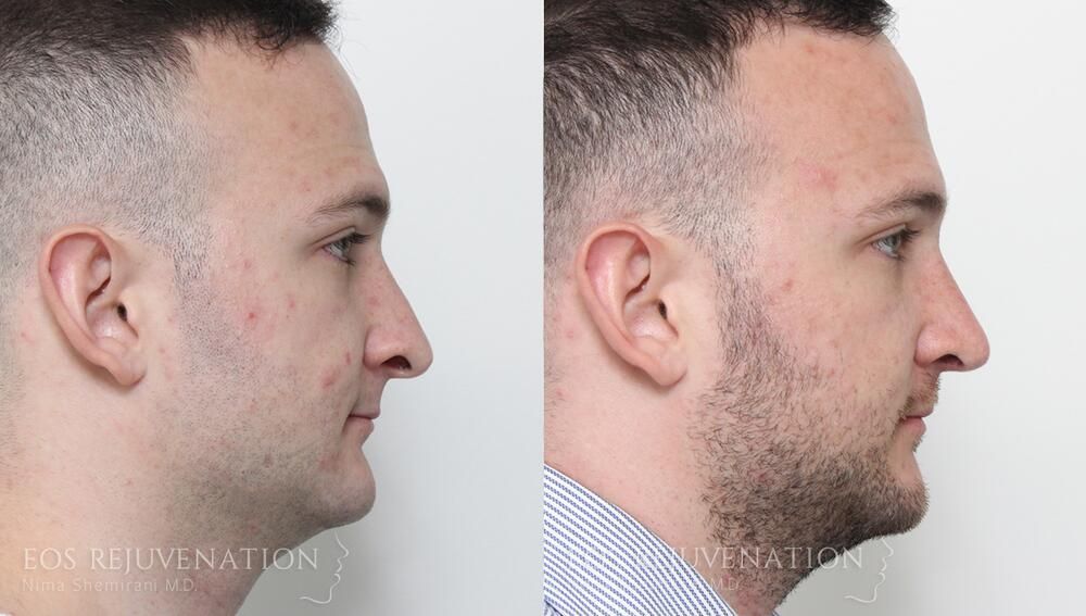 Male Rhinoplasty Before & After