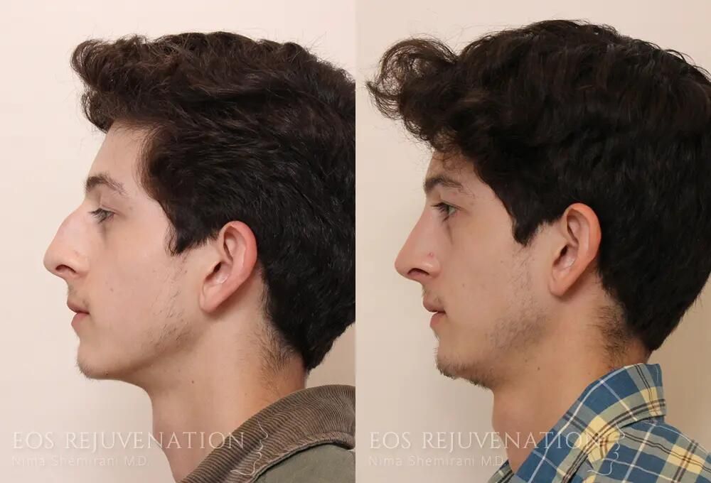 Male Rhinoplasty Before & After