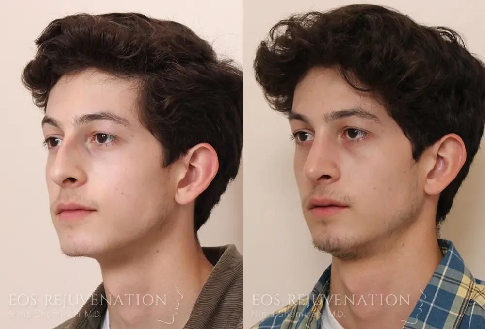 Male Rhinoplasty Before & After
