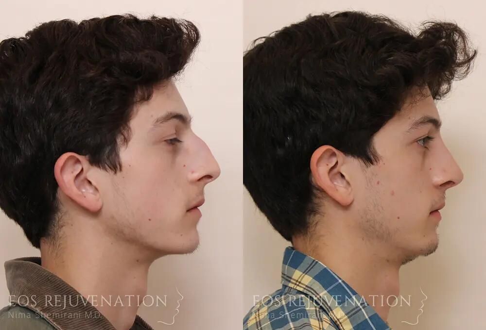 Male Rhinoplasty Before & After