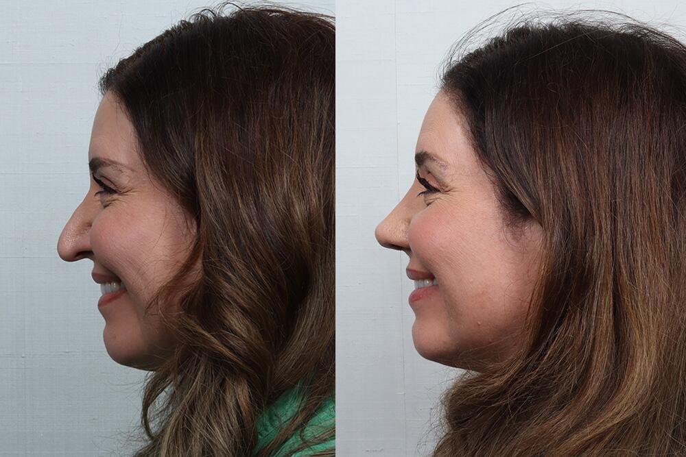 Revision Rhinoplasty Before & After