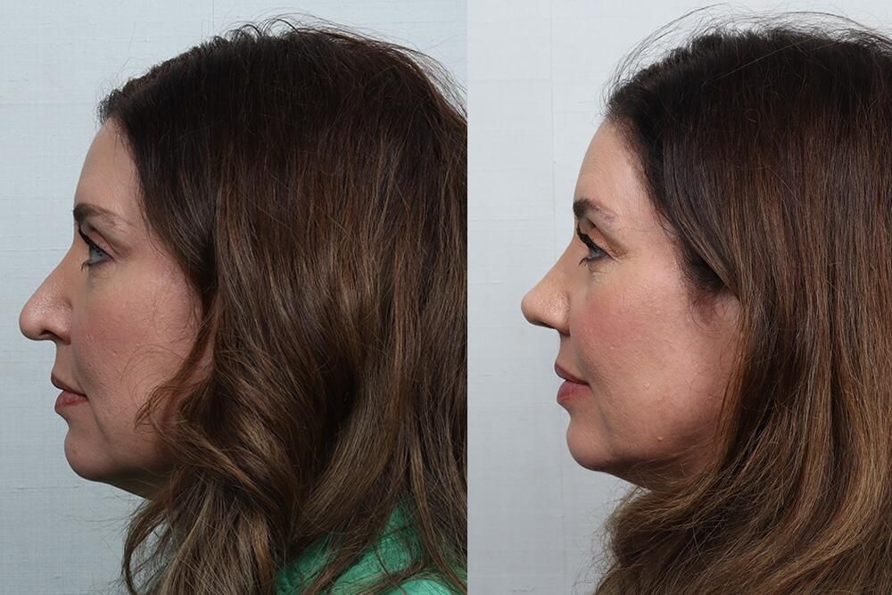 Revision Rhinoplasty Before & After