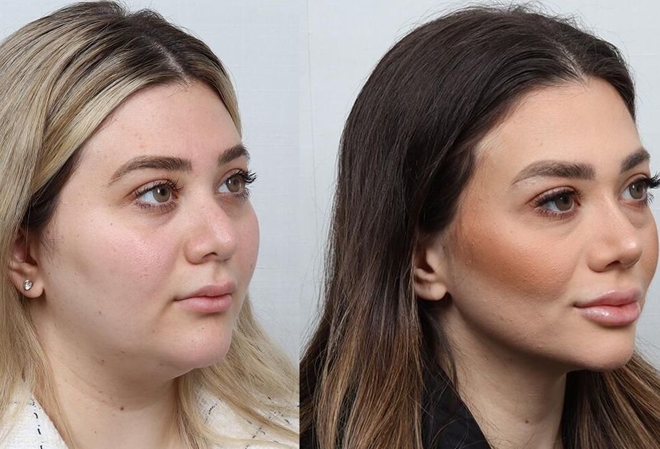 Revision Rhinoplasty Before & After