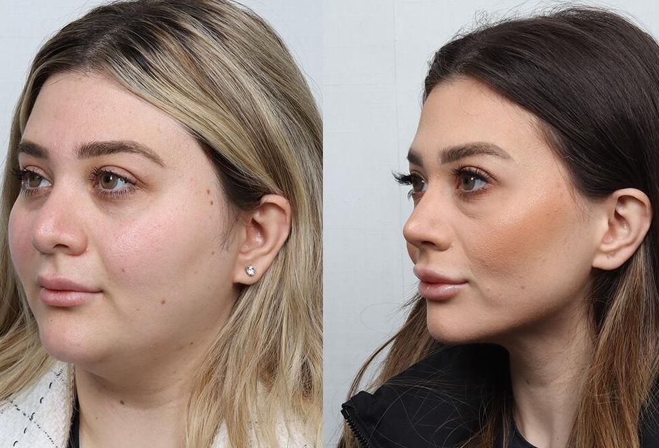 Revision Rhinoplasty Before & After