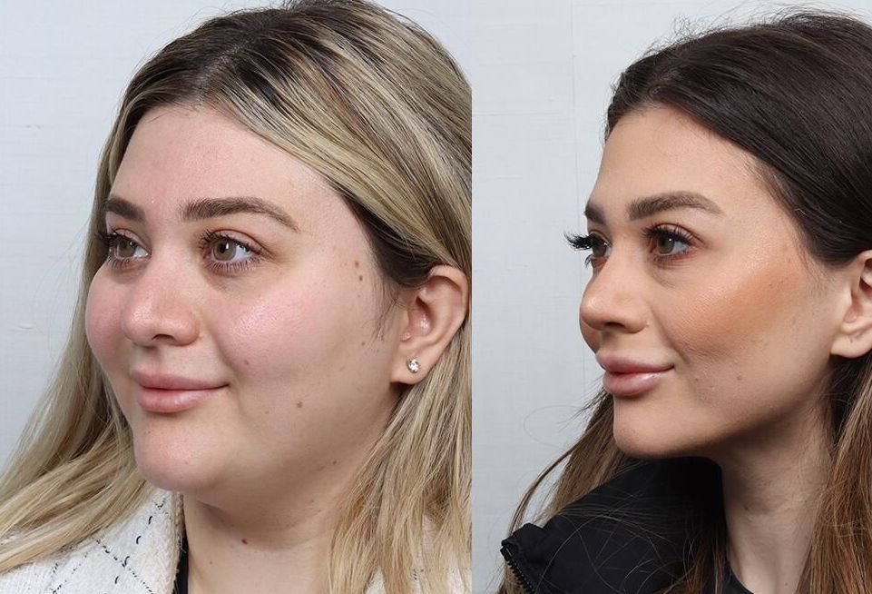 Revision Rhinoplasty Before & After