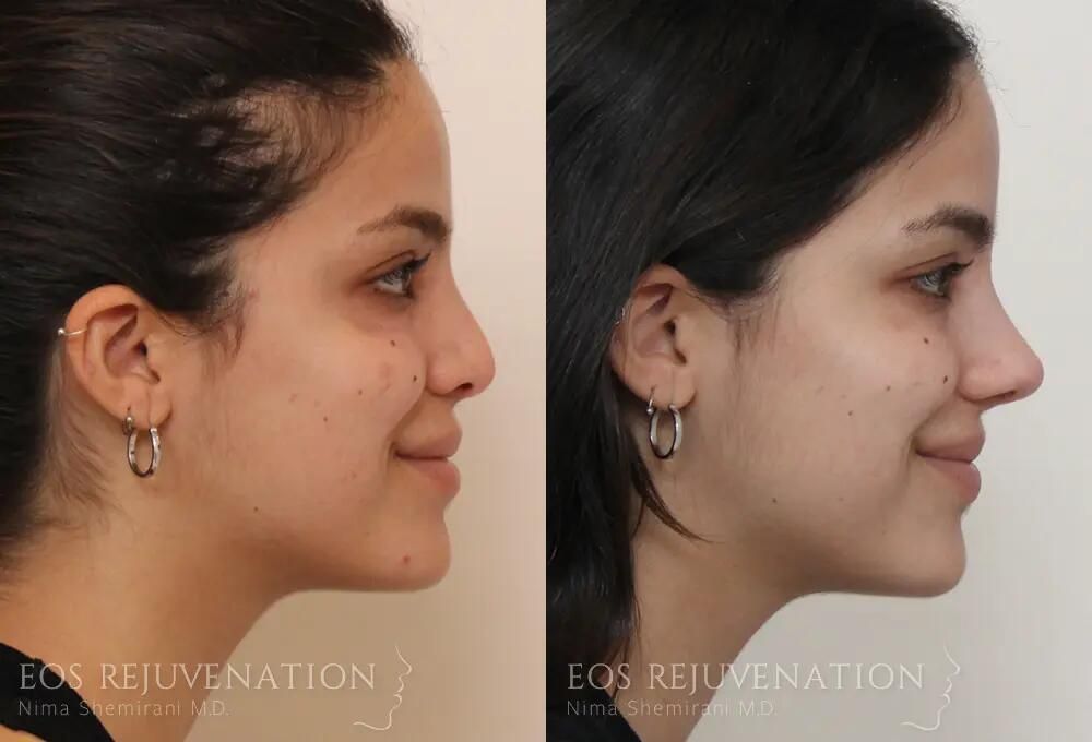 Revision Rhinoplasty Before & After