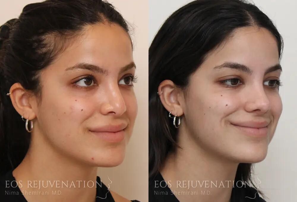 Revision Rhinoplasty Before & After