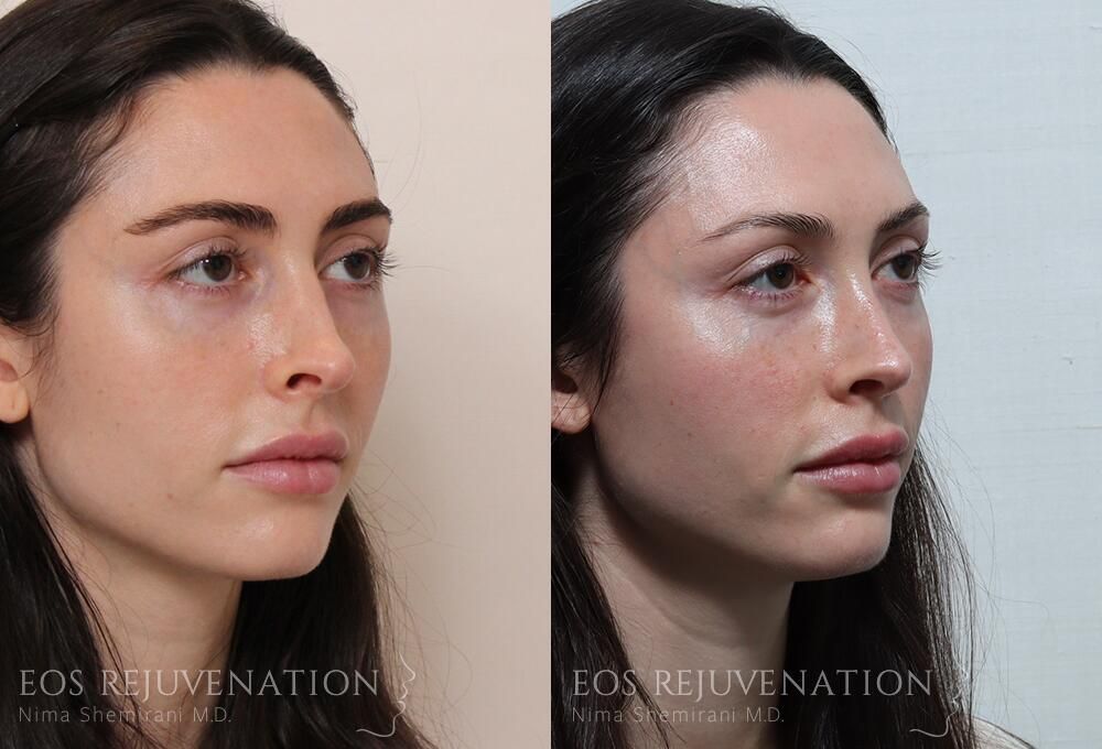 Revision Rhinoplasty Before & After