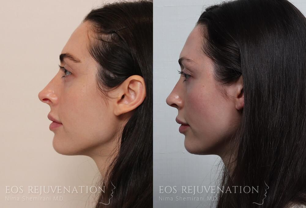 Revision Rhinoplasty Before & After