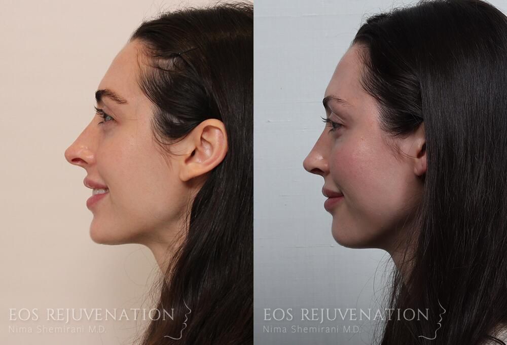 Revision Rhinoplasty Before & After