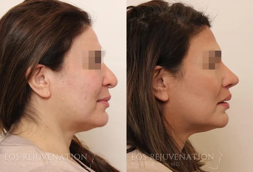 Revision Rhinoplasty Before & After