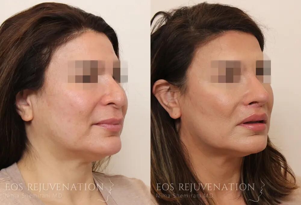 Revision Rhinoplasty Before & After