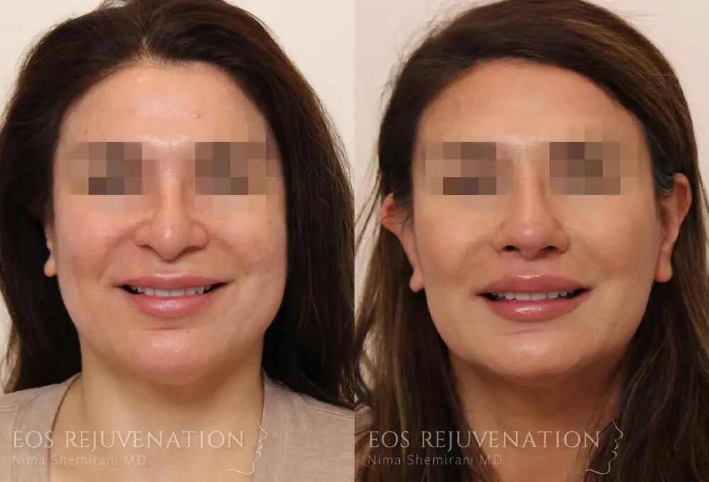 Revision Rhinoplasty Before & After