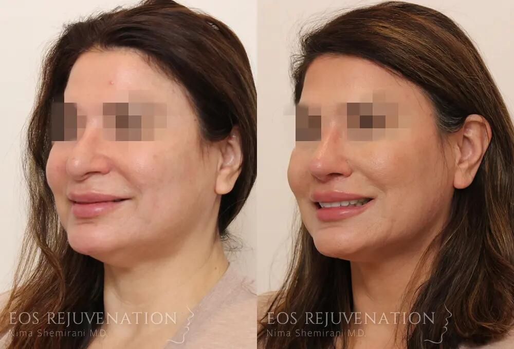 Revision Rhinoplasty Before & After
