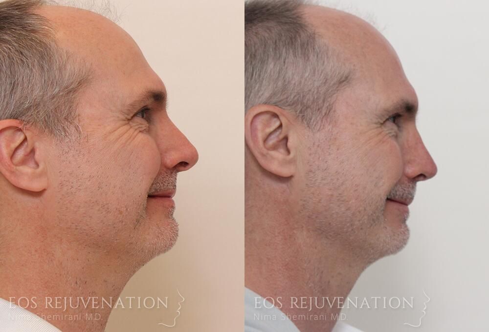 Revision Rhinoplasty Before & After