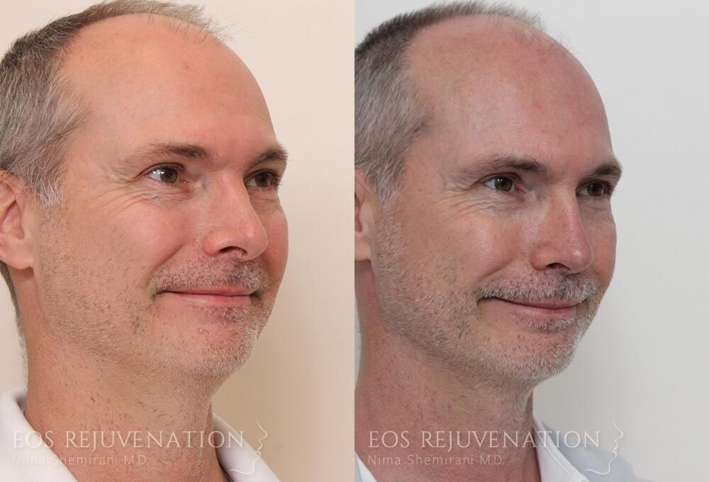 Revision Rhinoplasty Before & After