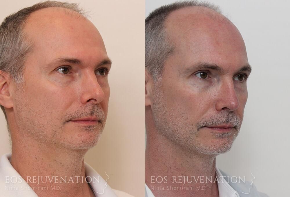 Revision Rhinoplasty Before & After
