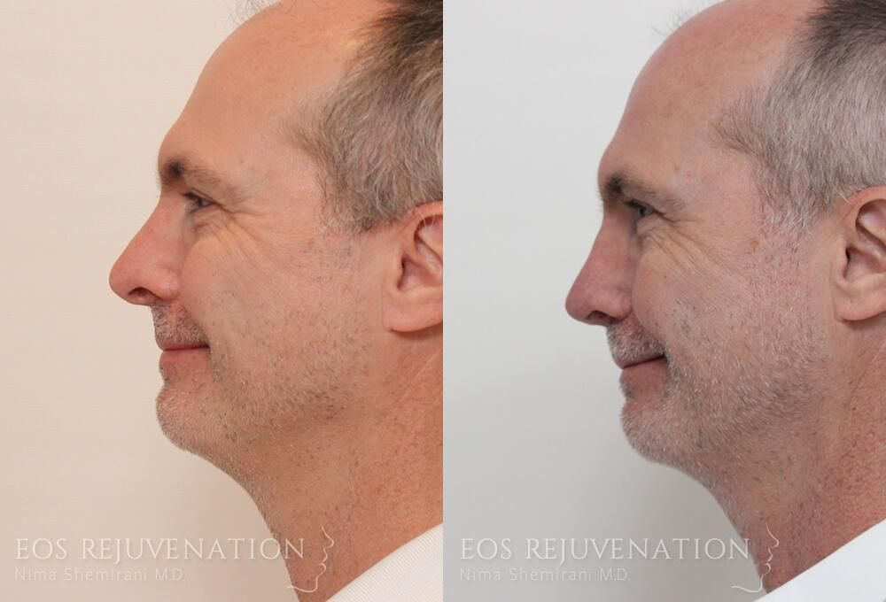 Revision Rhinoplasty Before & After