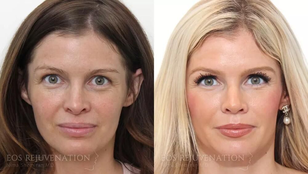 Revision Rhinoplasty Before & After