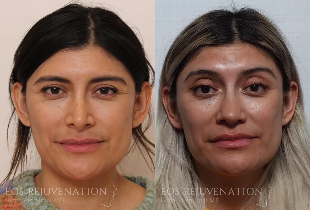 Revision Rhinoplasty Before & After