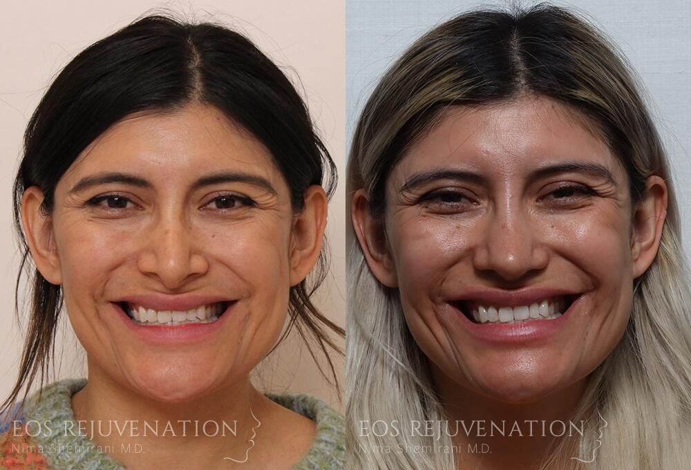 Revision Rhinoplasty Before & After