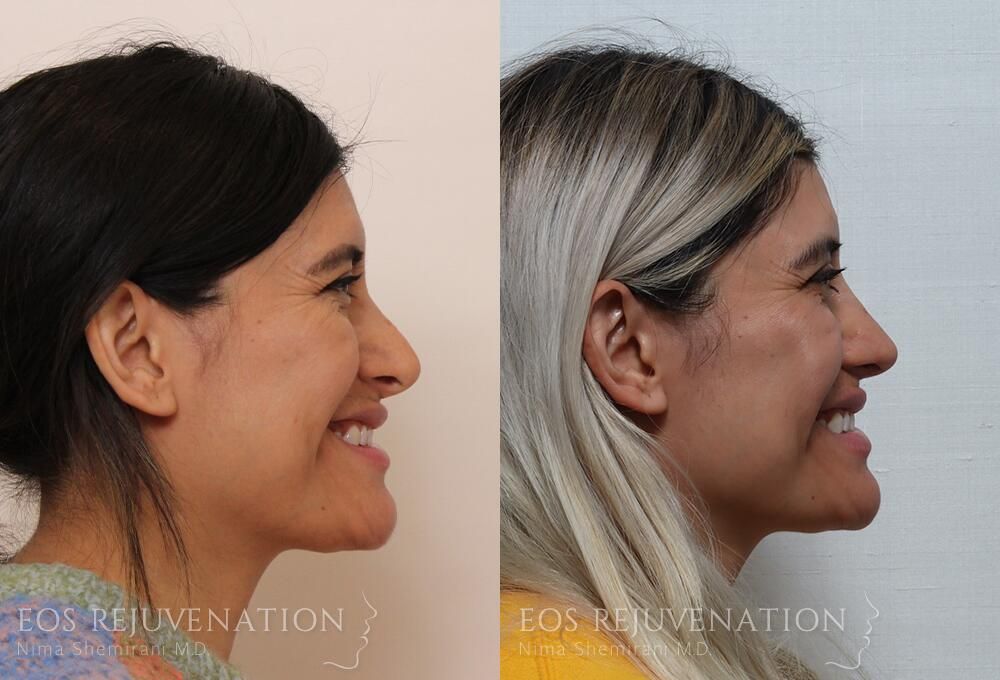 Revision Rhinoplasty Before & After