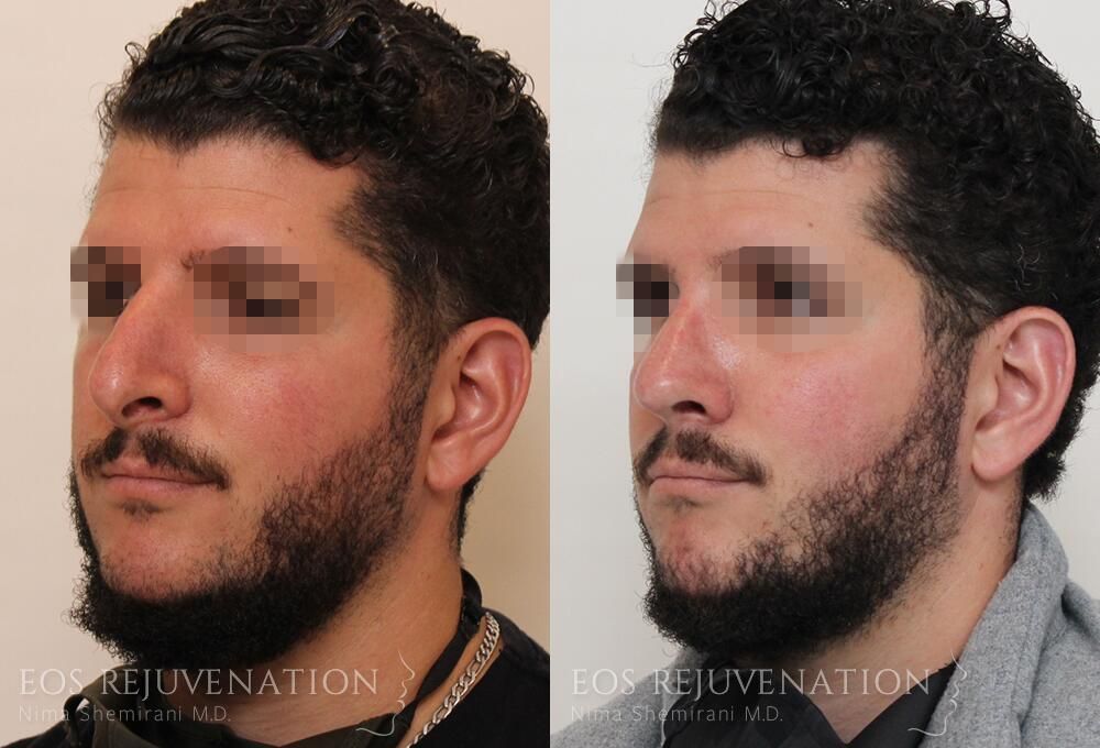 Revision Rhinoplasty Before & After